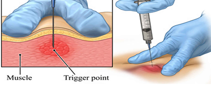 Chiropractic Portland OR Trigger Point Injections